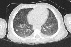 CT scan from January